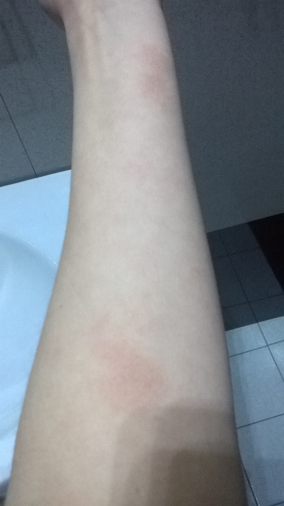 Фото 1. Зудящие пятна на коже