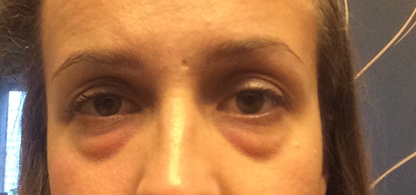 Фото 2. Мешки под глазами