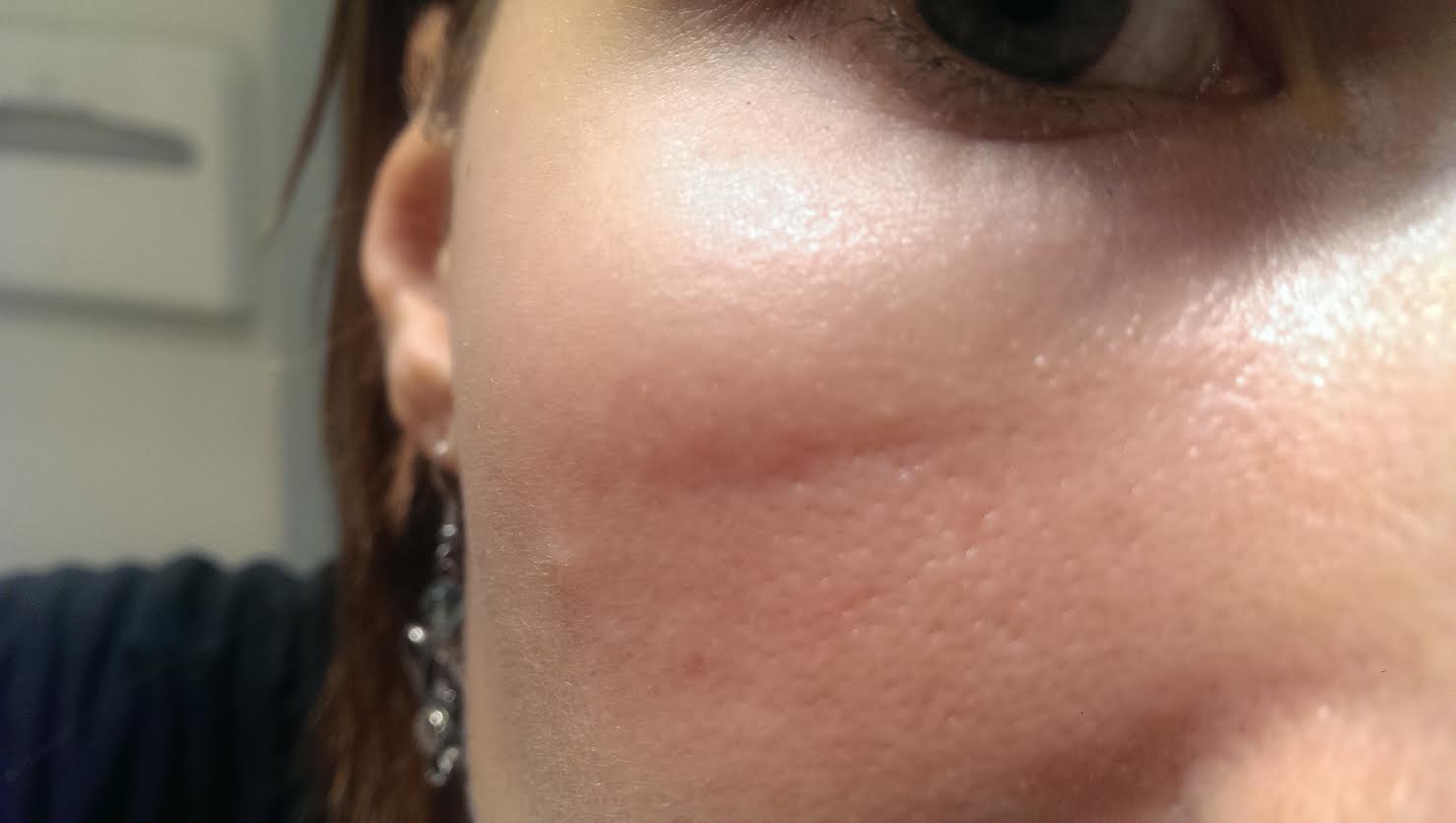 Фото 1. Как можно убрать рубцы на лице?