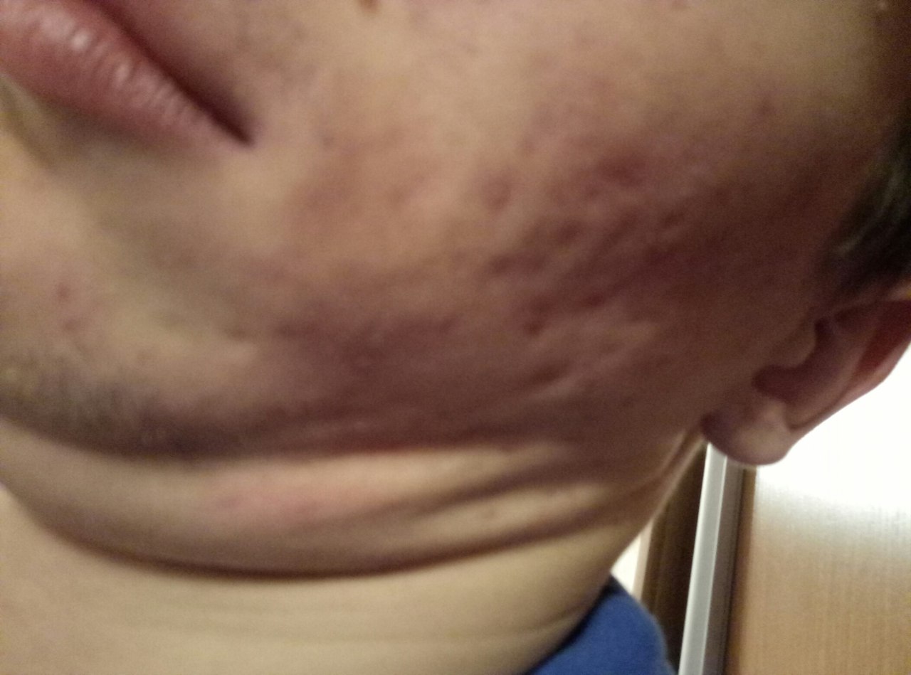 Фото 1. Рубцы после акне