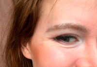 Фото 1. Беспокоит кожа нижних век