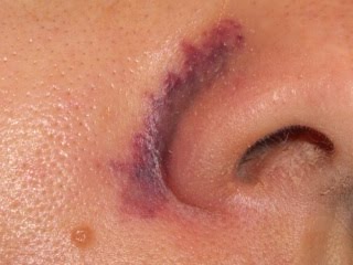 Фото 3. не получилось удалить лазером...