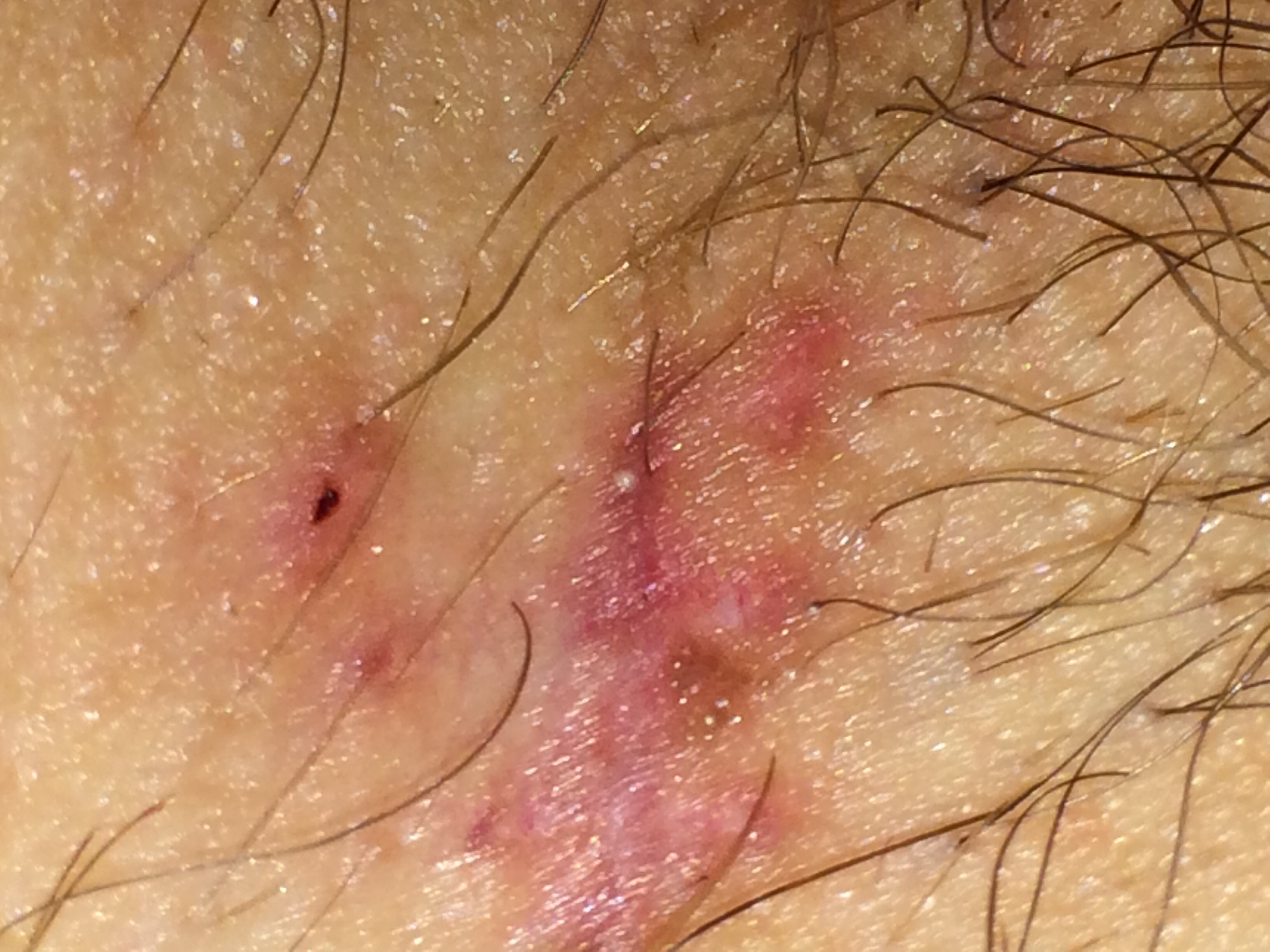 Фото 1. опасна ли родинка