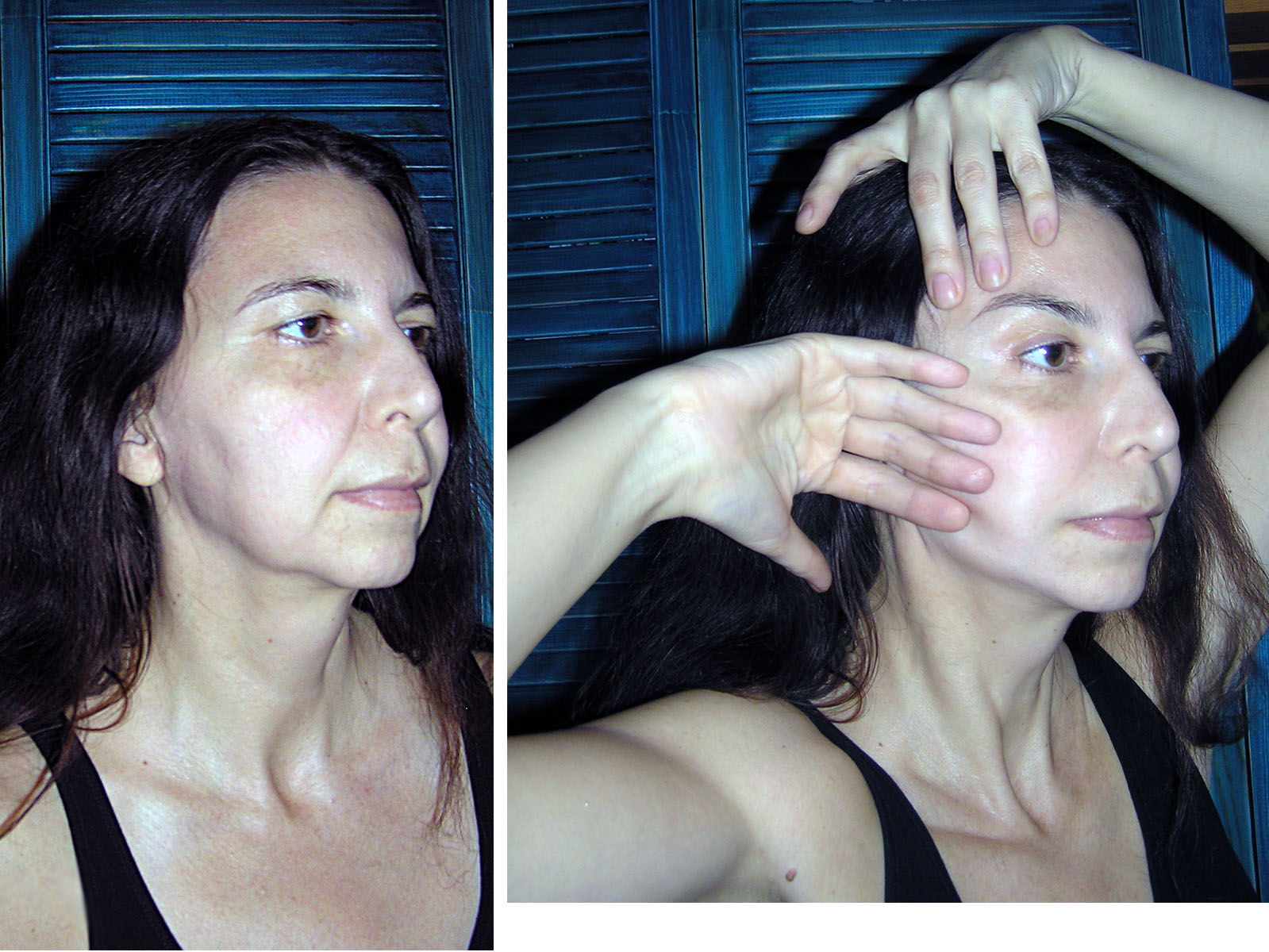 Фото 1. Подтяжка лица