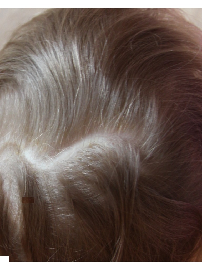 Фото 1. Как убрать рубец у ребенка?