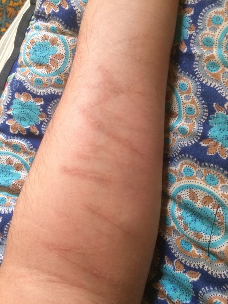 Фото 1. Как избавиться от шрама на руке?