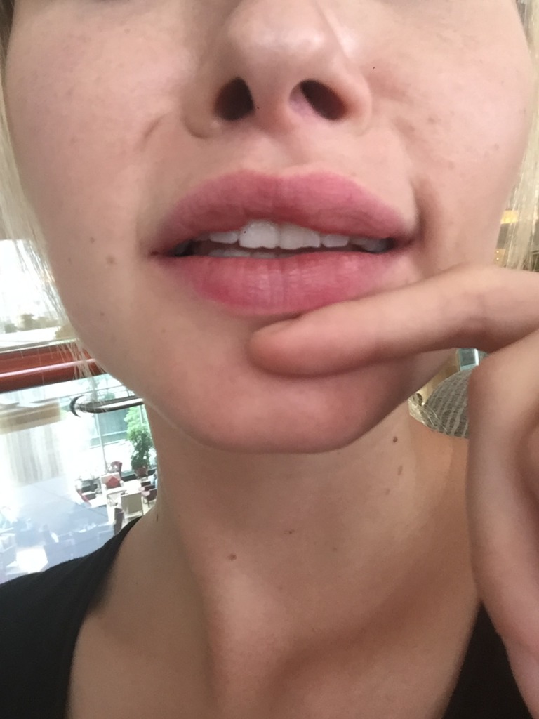 Фото 1. Шарики в верхней губе после филлера Juvederm