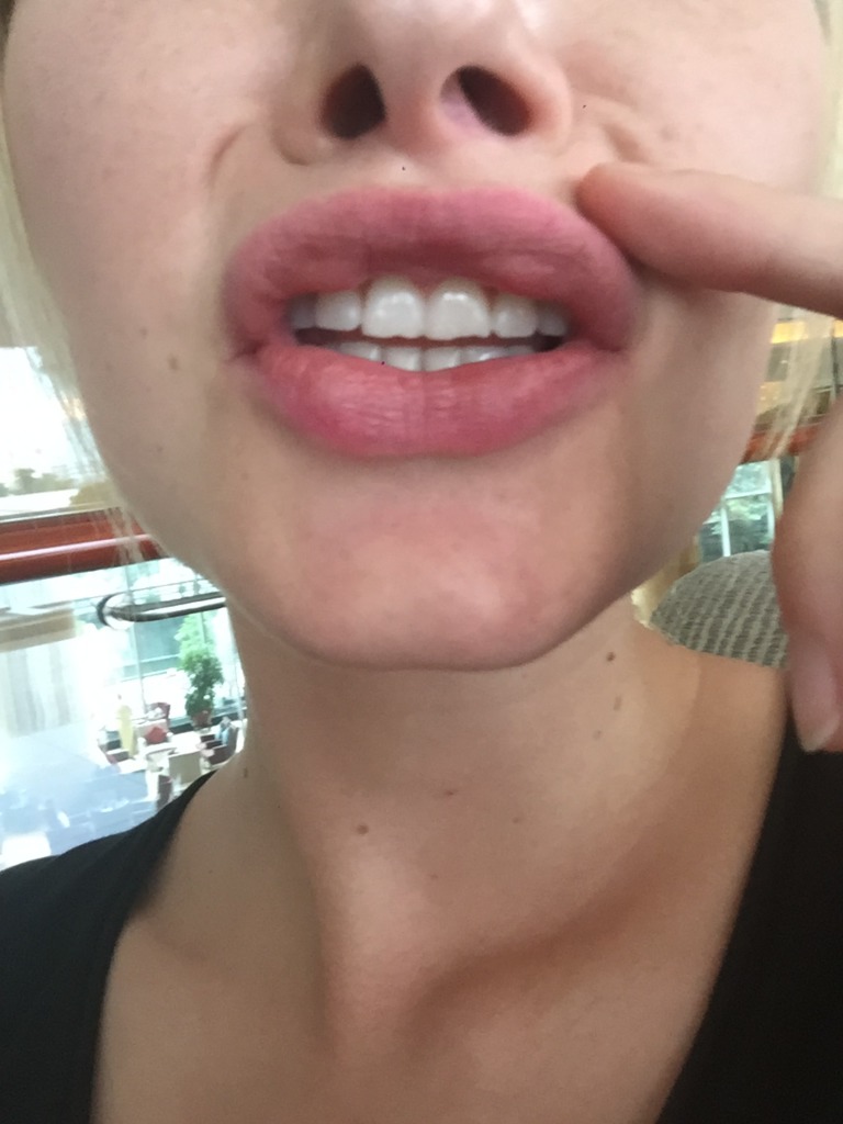 Фото 2. Шарики в верхней губе после филлера Juvederm