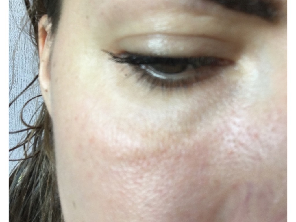 Фото 1. Выпирает суф после Ювидерм Волюма