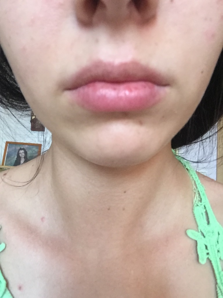 Фото 1. Как исправить асимметрию верхней губы?