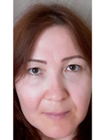 Фото 1. Чем лучше сделать межбровье, носогубки и область вокруг глаз?