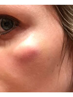 Фото 3. Отек после juviderm 4