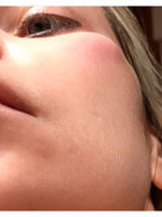 Фото 4. Отек после juviderm 4