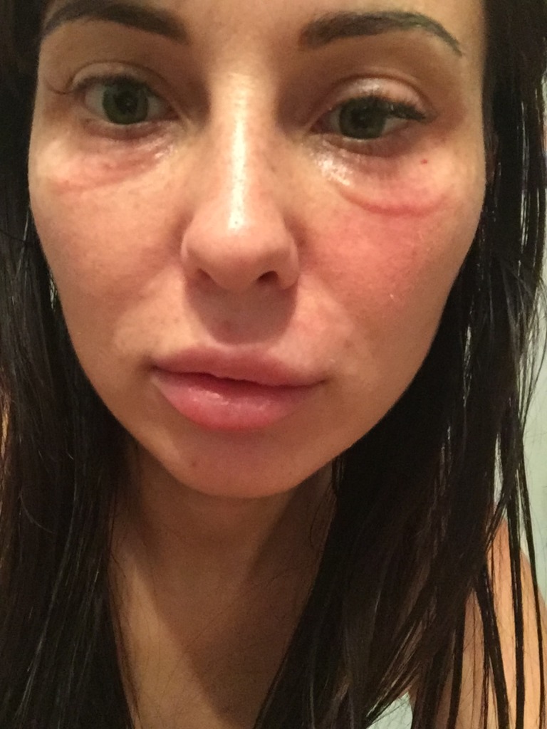 Фото 1. Покраснение и отек вокруг глаз после BTX Aquashine