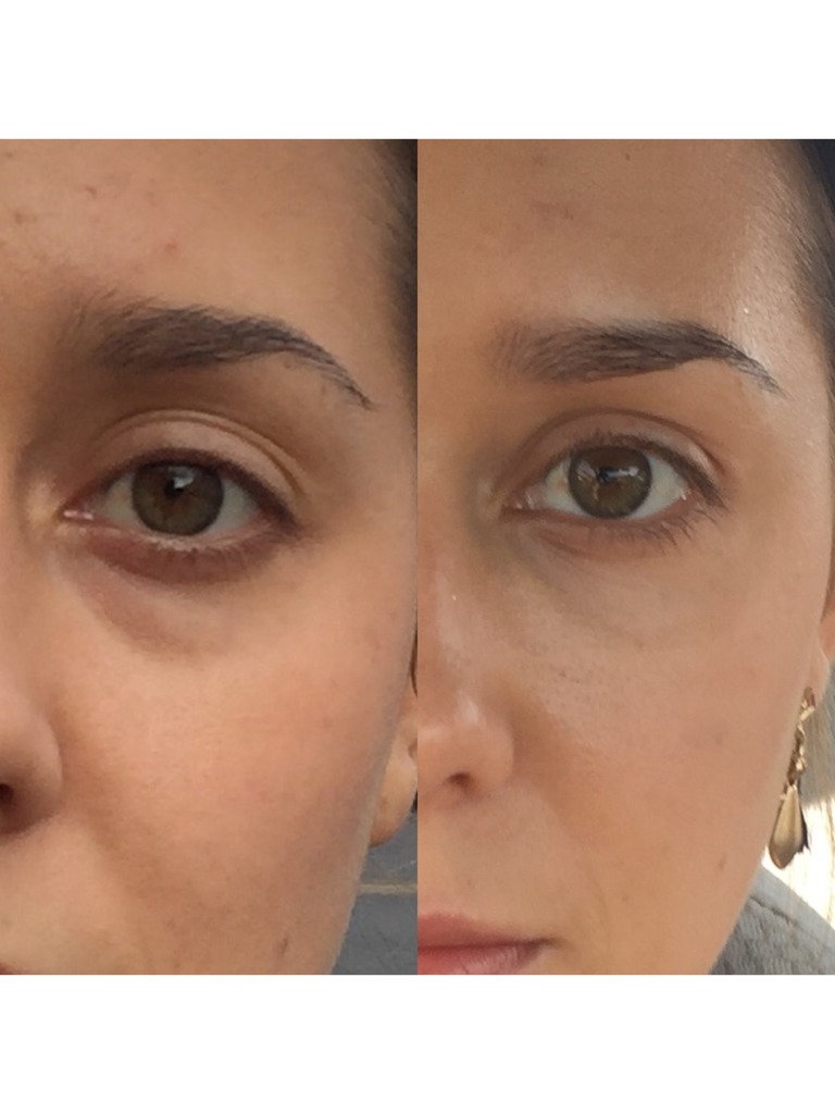 Фото 1. Ювидерм в носослезные борозды