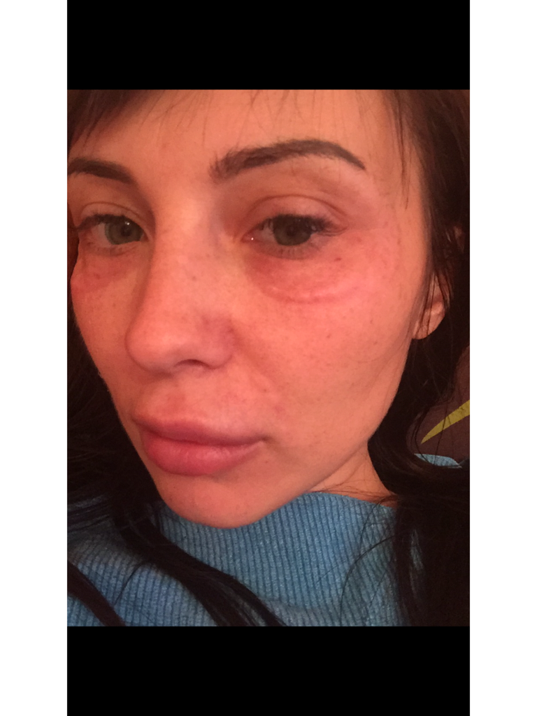 Фото 2. Покраснение и отек вокруг глаз после BTX Aquashine