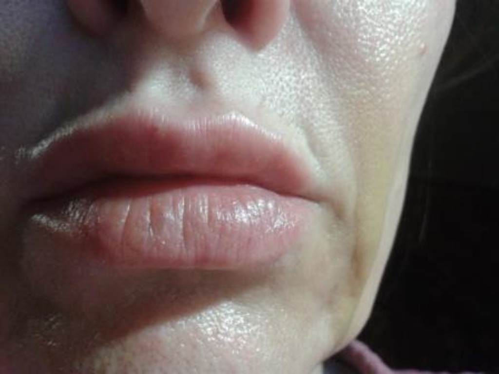 Фото 1. После Ювидерм в губы мелкие пузырьки
