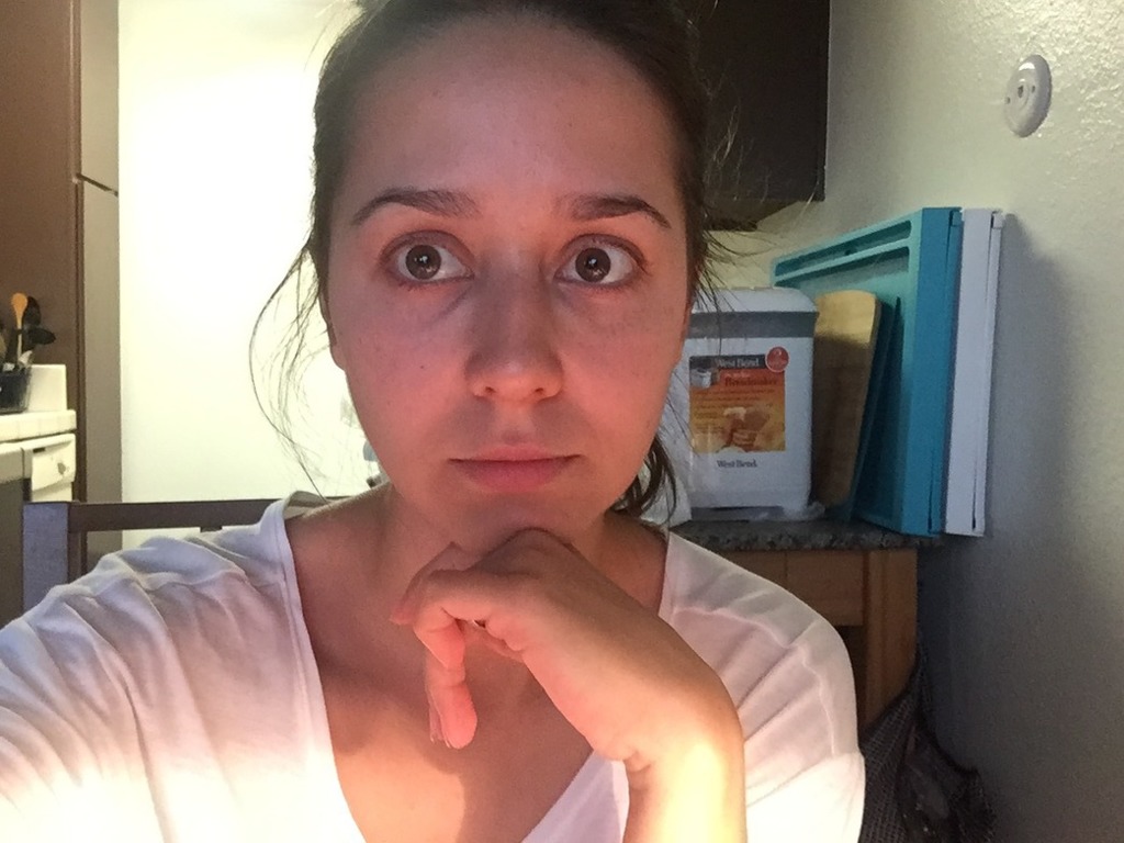 Фото 2. Ювидерм в носослезные борозды