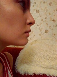 Фото 2. Подвижность кончика носа после ринопластики