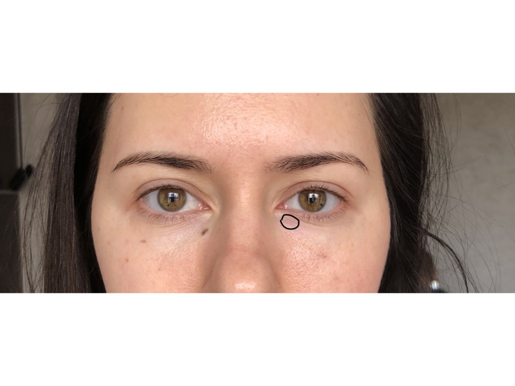 Фото 1. Заполнение носослезной борозды Теосиаль. Может ли пройти уплотнение само?