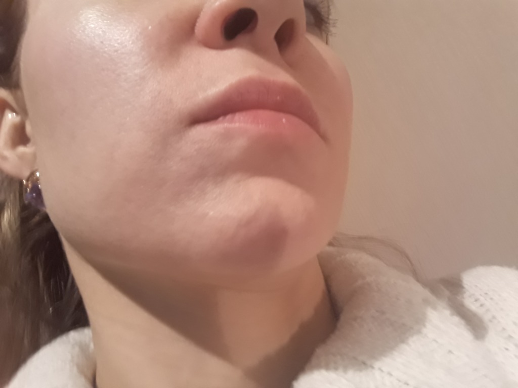 Фото 1. Фиброз после филлера ILLUMICA form