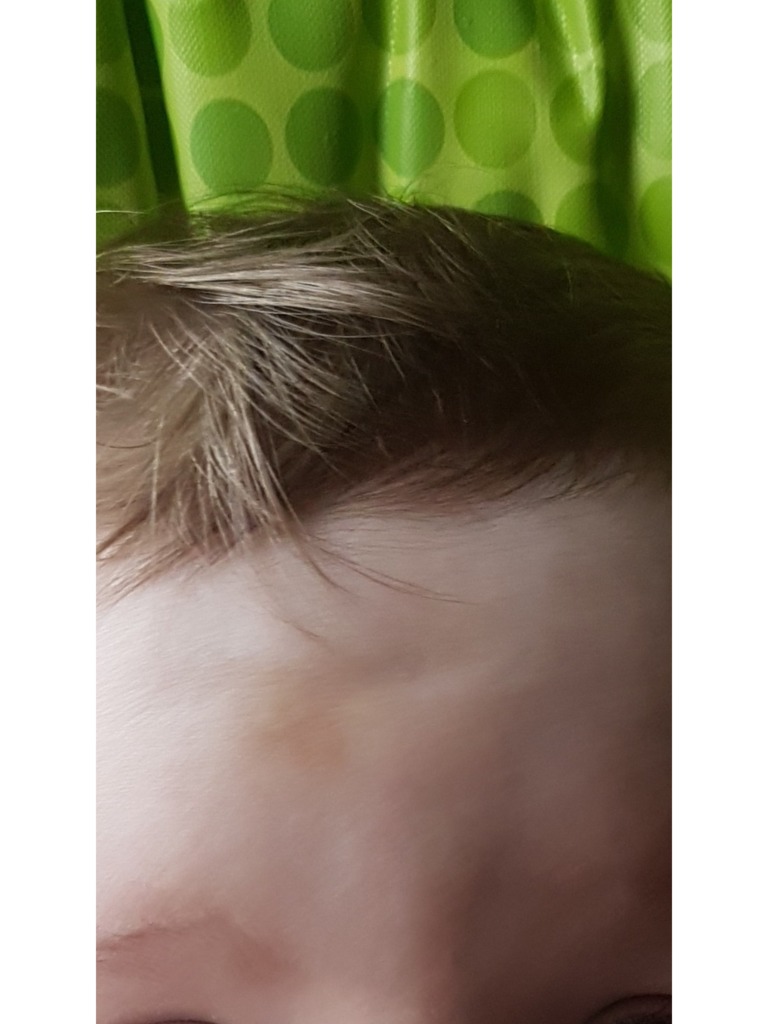 Фото 1. Подкожный рубец у ребенка на лбу