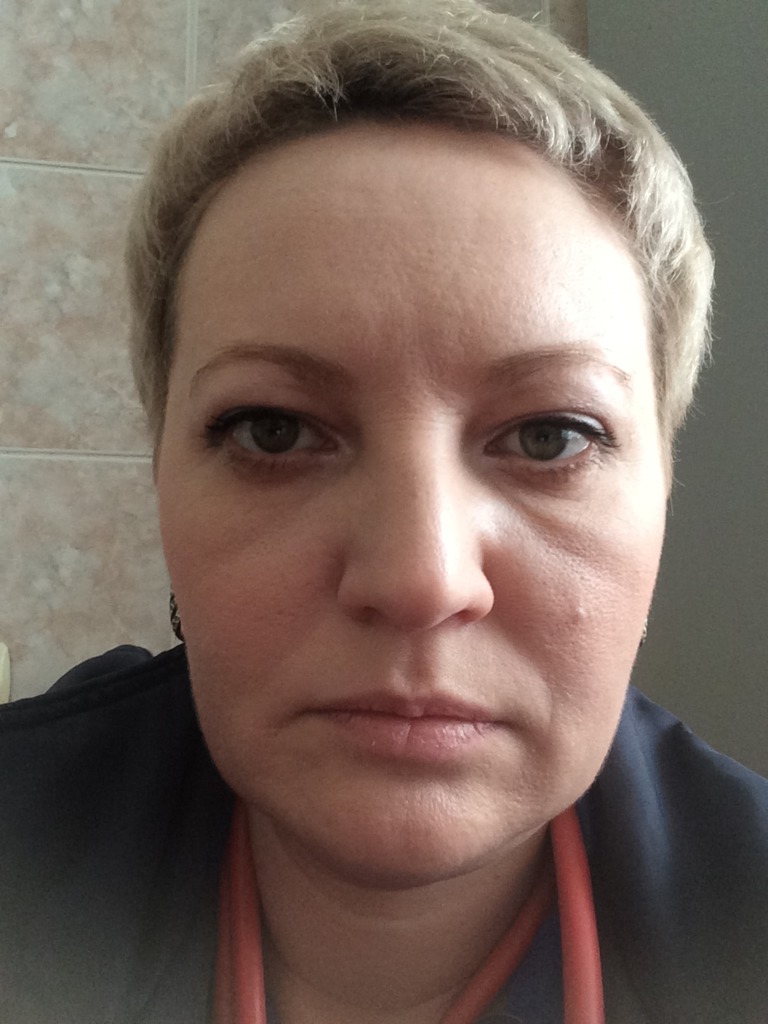 Фото 1. Нити Cog с филлером Evolution и Релатокс дали отеки и  ассиметрию. Что делать?