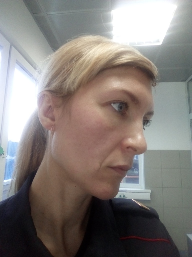 Фото 2. Можно ли убрать носогубки увеличением  скул?