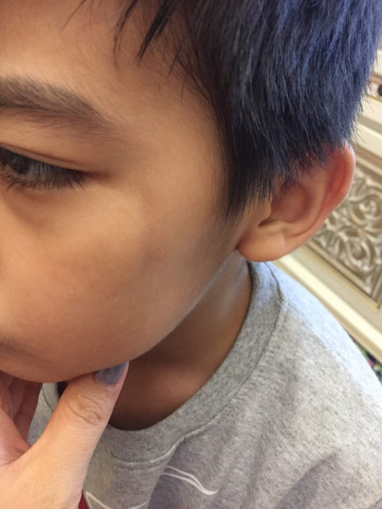 Фото 1. Подкожный рубец у ребенка