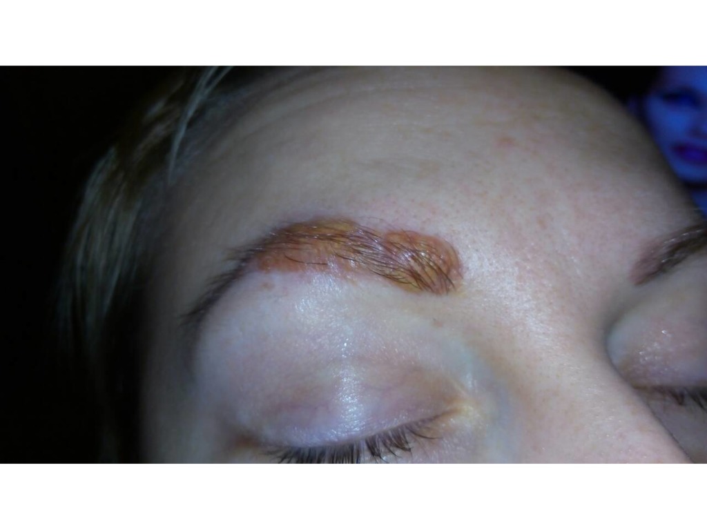 Фото 2. Сделала микроблейдинг и через 8 месяцев образовался келоидный рубец