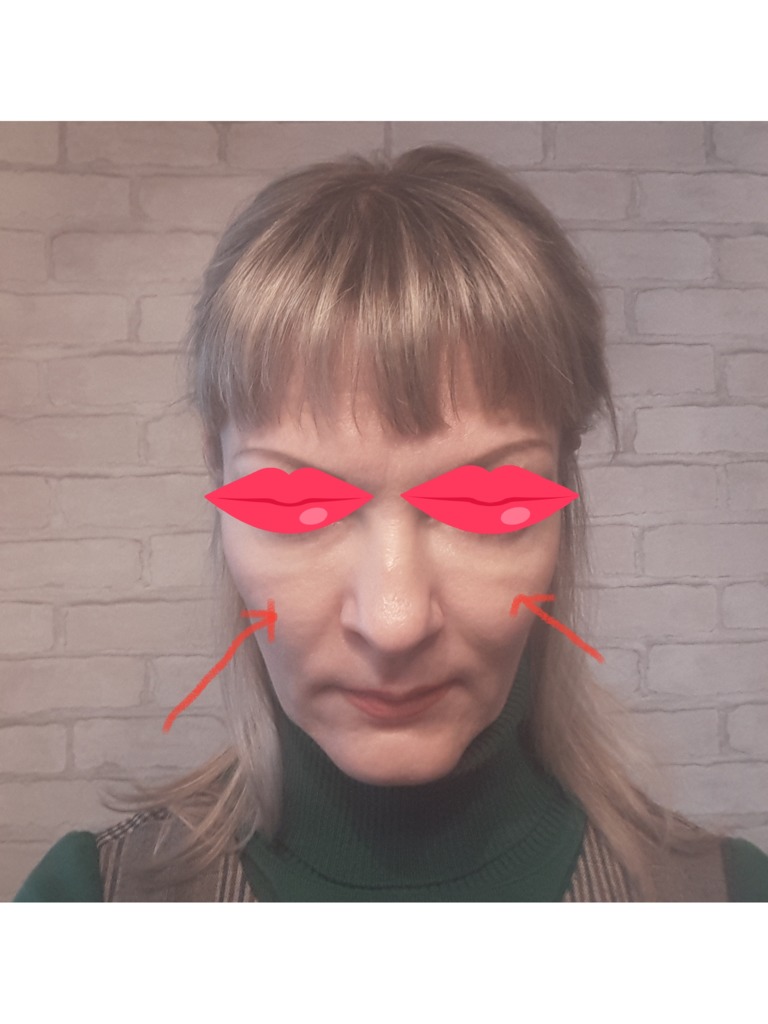 Фото 1. После Белотеро под глазами появились припухлые валики