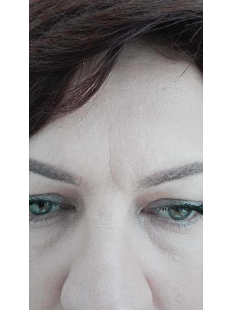 Фото 1. Как убрать межбровную морщину? Что посоветуете?