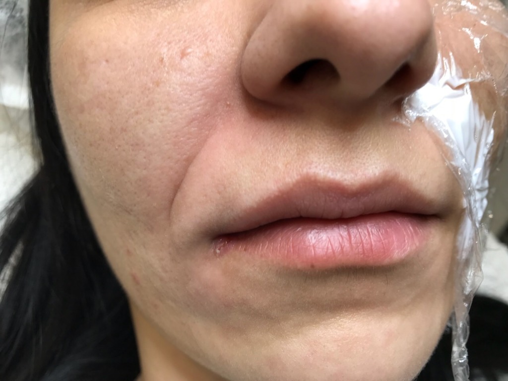Фото 1. После принцес в носогубках темные пятна вместах введения. Как это откорректировать?