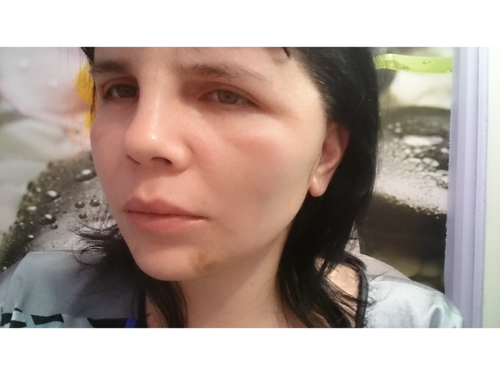 Фото 1. Беспокоят глаза и слух после смас и блефаро