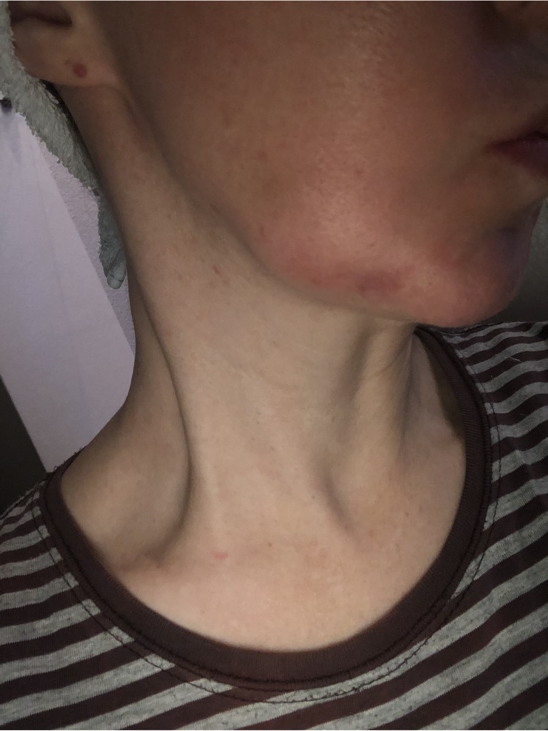 Фото 1. Как рассосать радиесс?