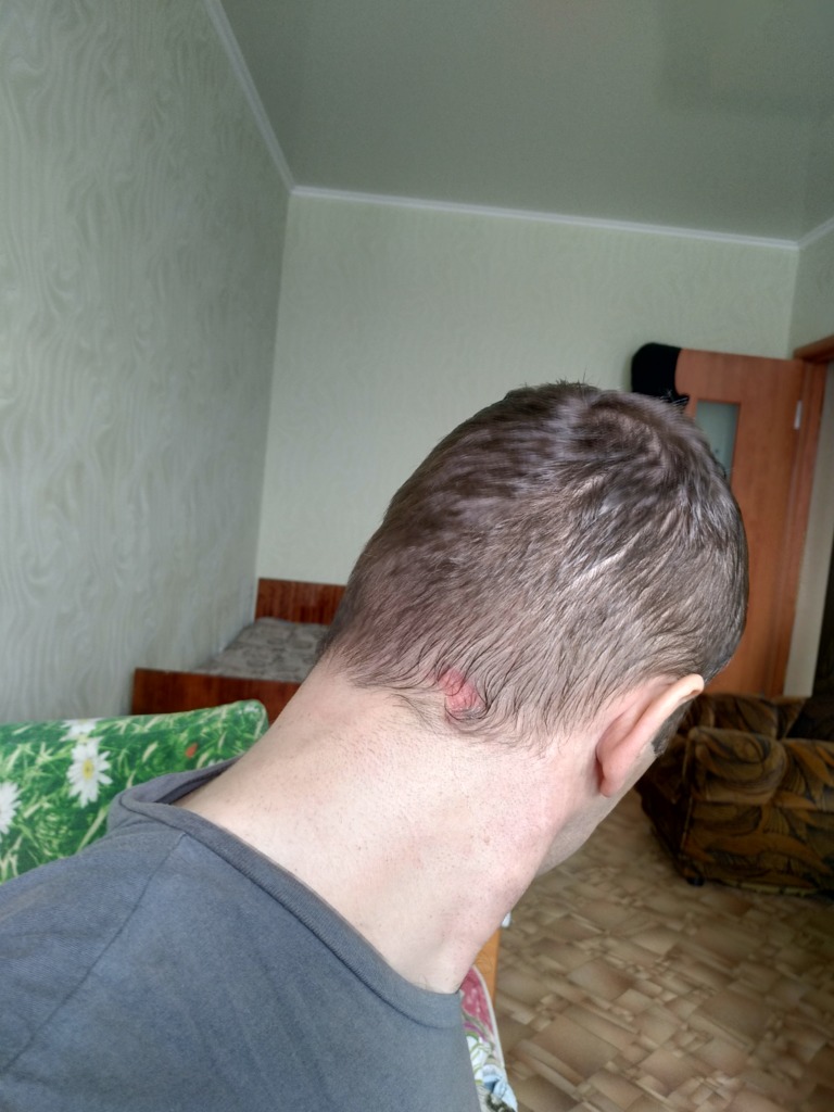 Фото 1. Как воостановить рост волос на шраме после ожога?