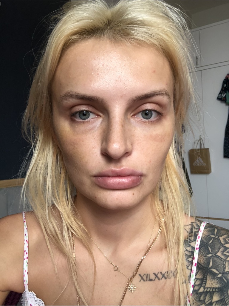 Фото 2. Мешок под глазом после введения филлера как убрать?