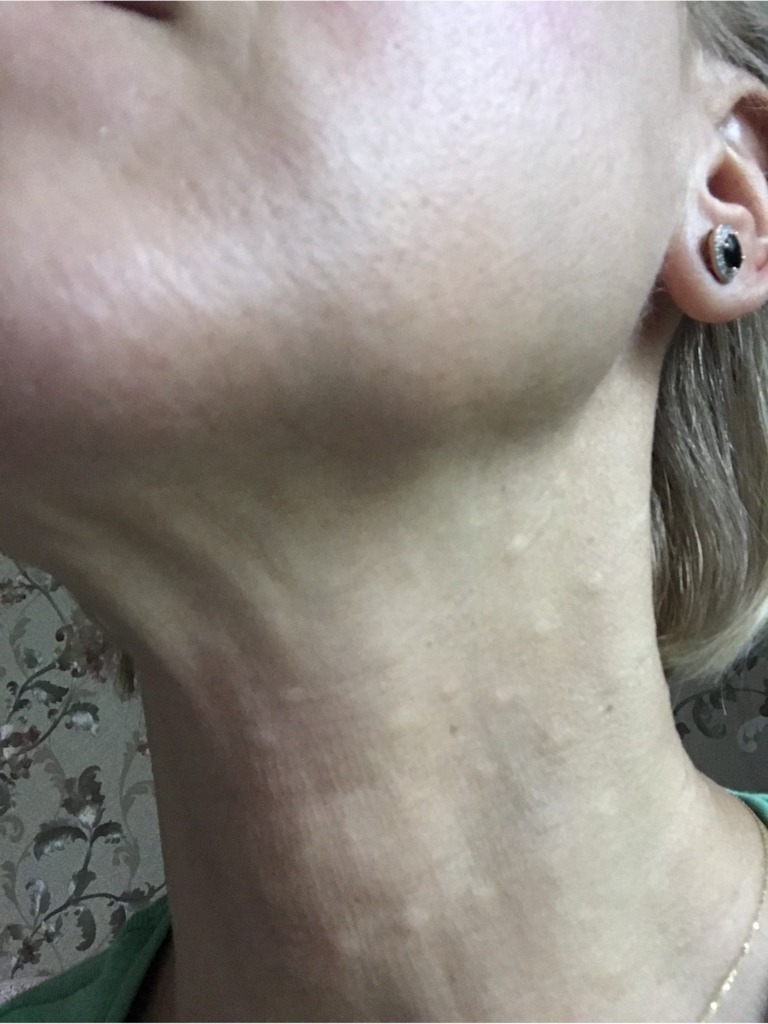 Фото 1. Не рассасываются папулы после Редженесс, а прошел уже месяц, это нормально?