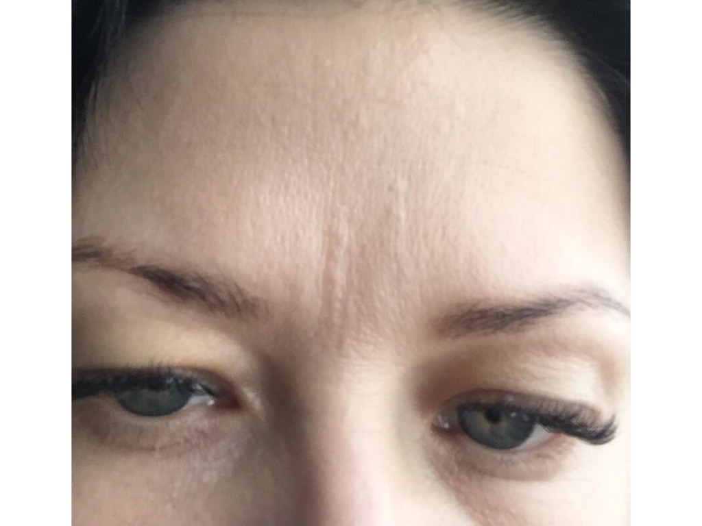 Фото 1. Межбровный залом превратился в шрамики после ботокса и филлера, как их убрать?