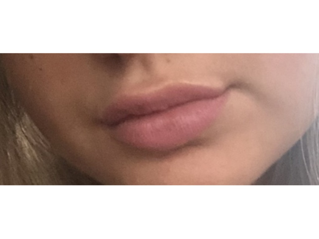 Фото 1. Не нравится результат после Ювидерм и Сурджидерм, что можно сделать?