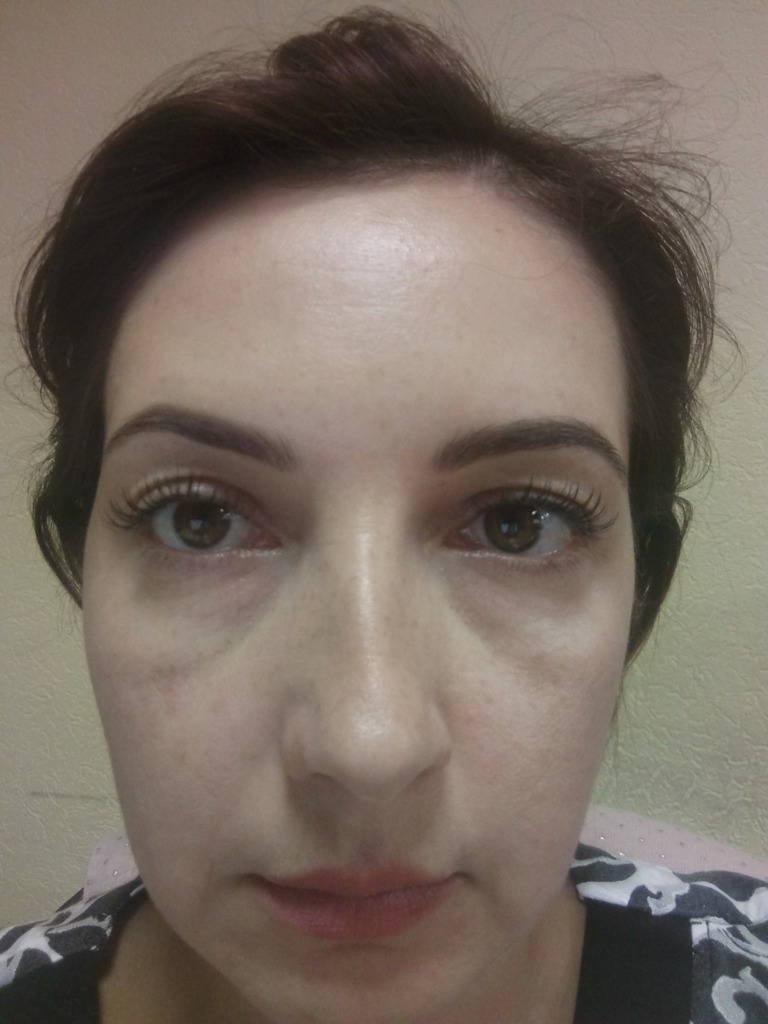 Фото 1. После мезоай под глазами усилилась синева и осталась припухлость. Как исправить?