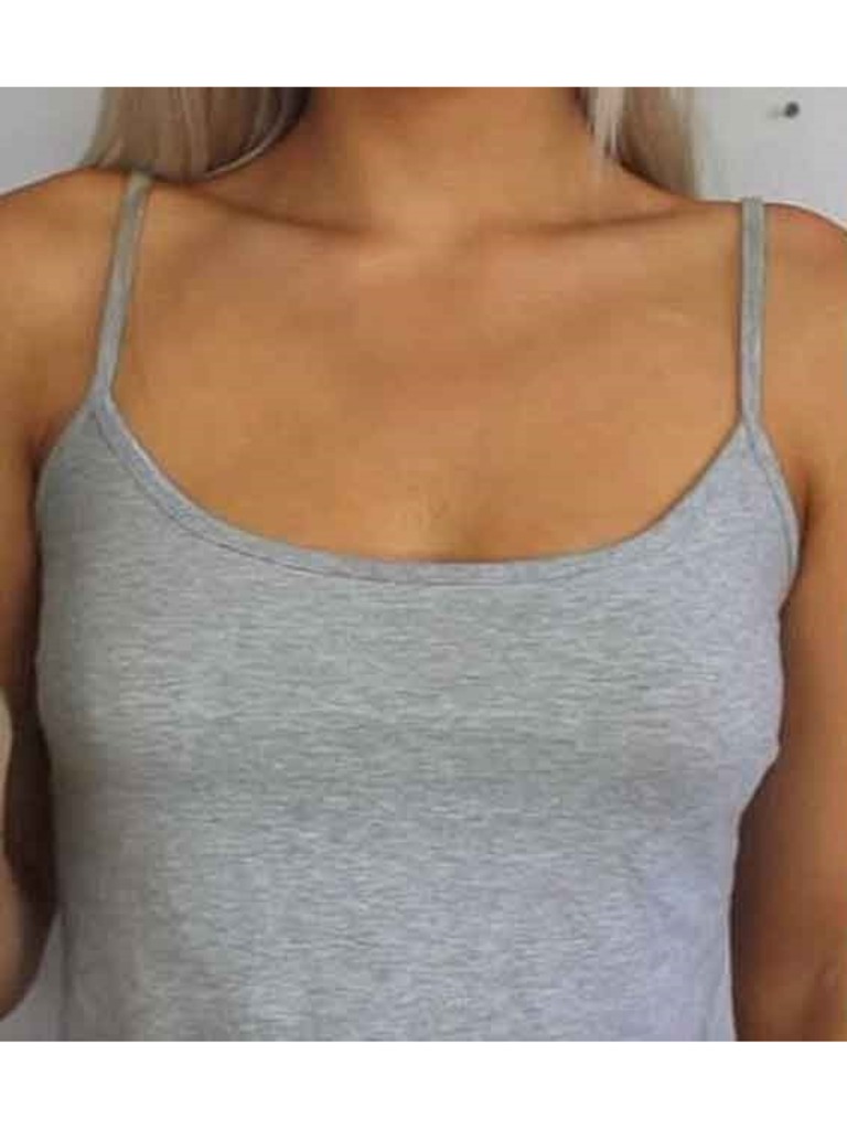 Фото 1. В чем разница имплантов для увеличения груди?