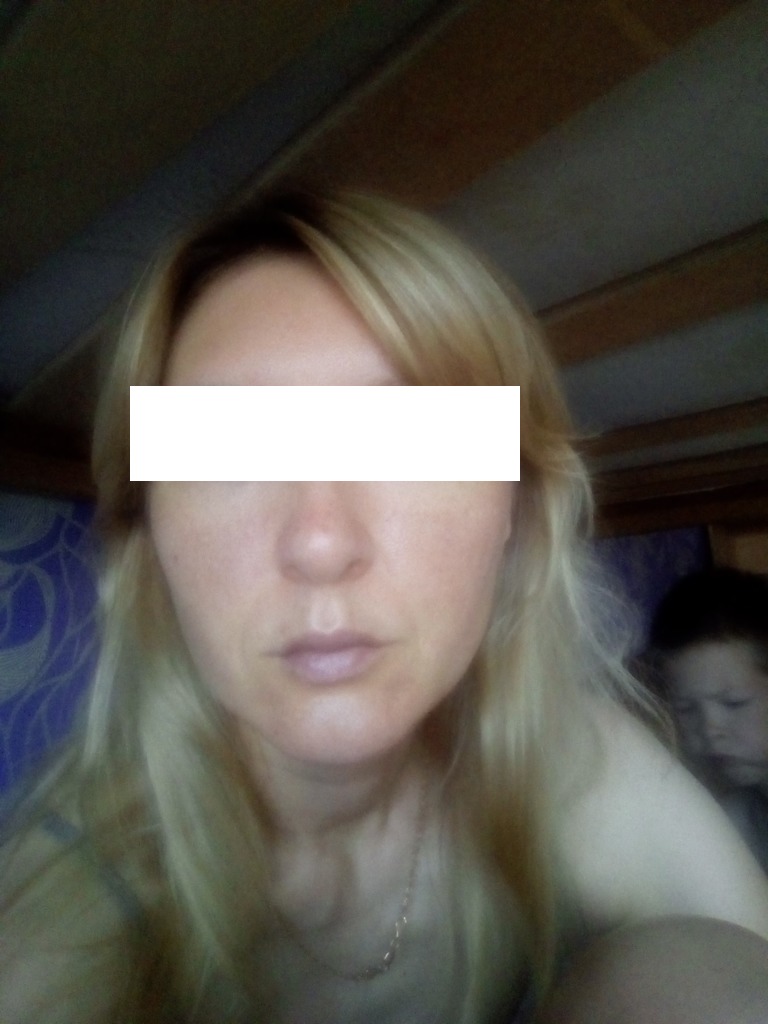 Фото 1. Болит и ноет щека после установки мезонитей, почему так?