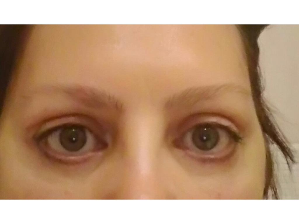 Фото 1. Каким способом можно убрать окурглость глаз после пластики век?