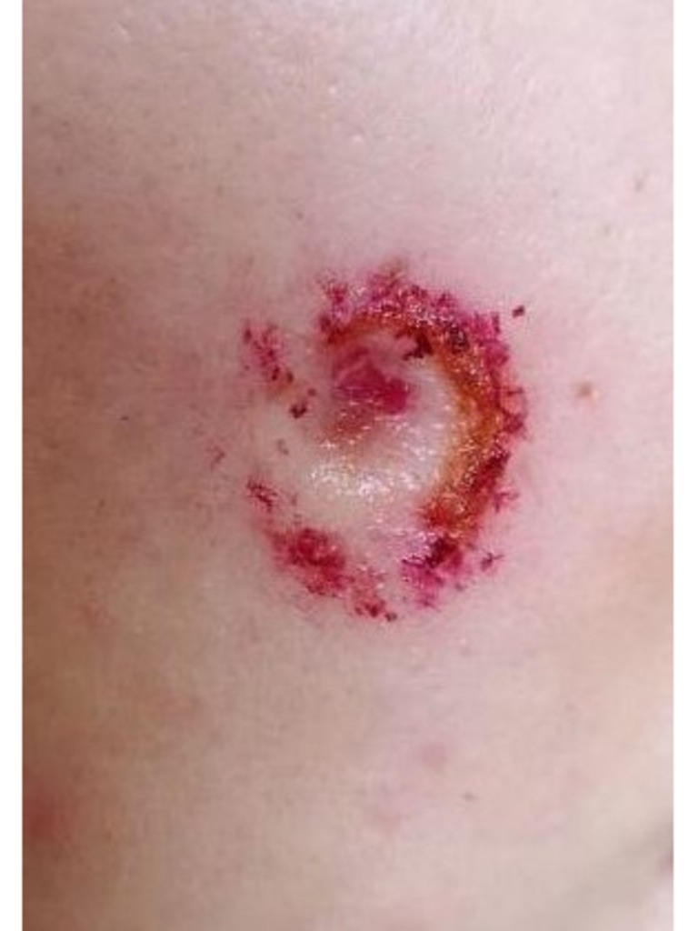 Фото 1. Что можно сделать, чтобы удалить атрофический рубец?