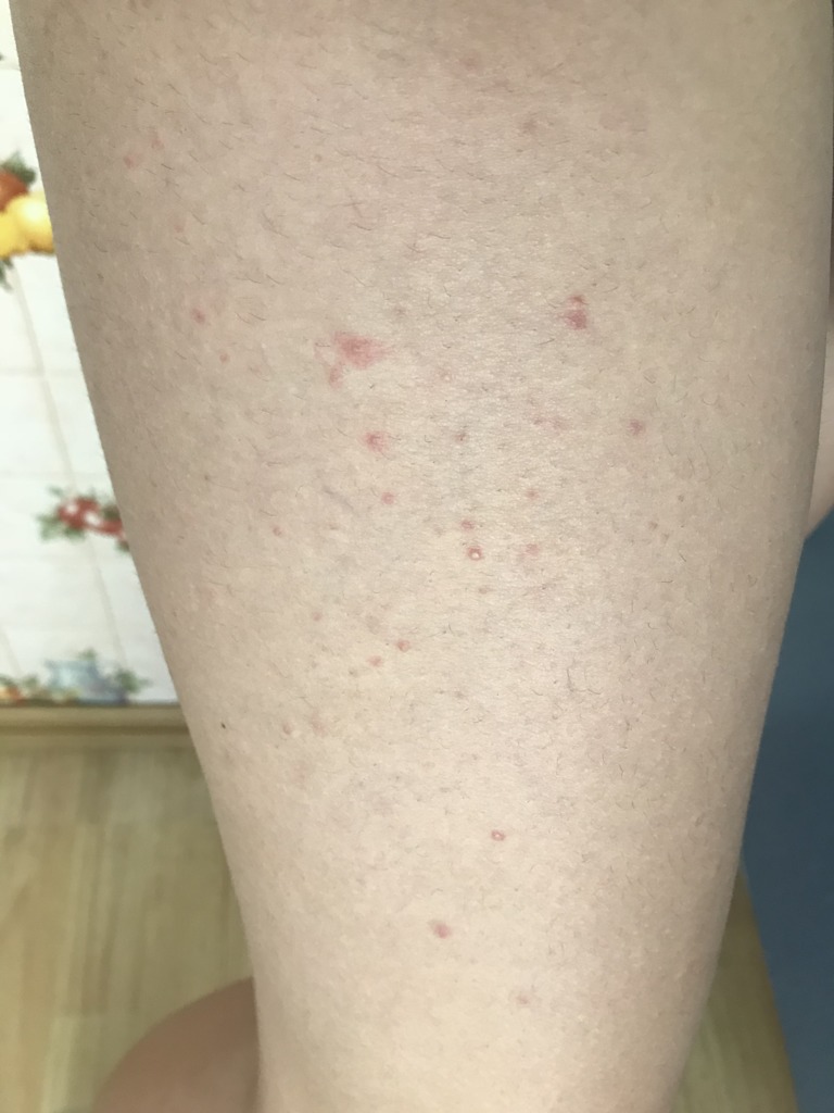 Фото 2. Как узнать причину сыпи?