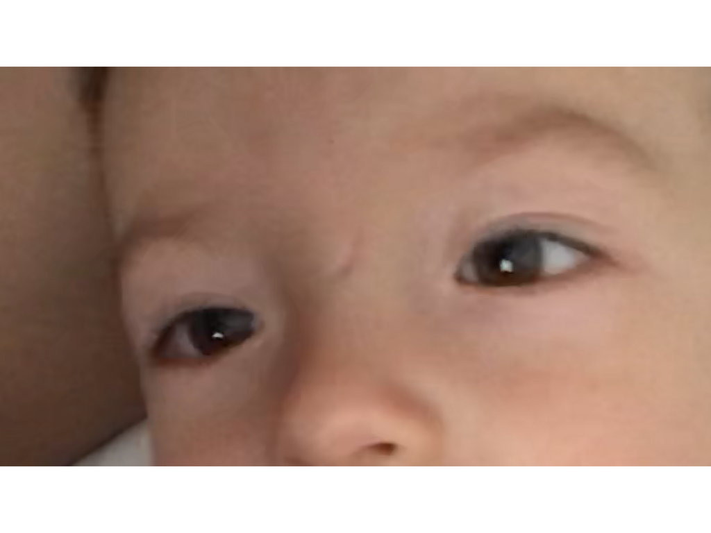 Фото 3. Как избавиться от рубца у ребенка в 2,4 года?