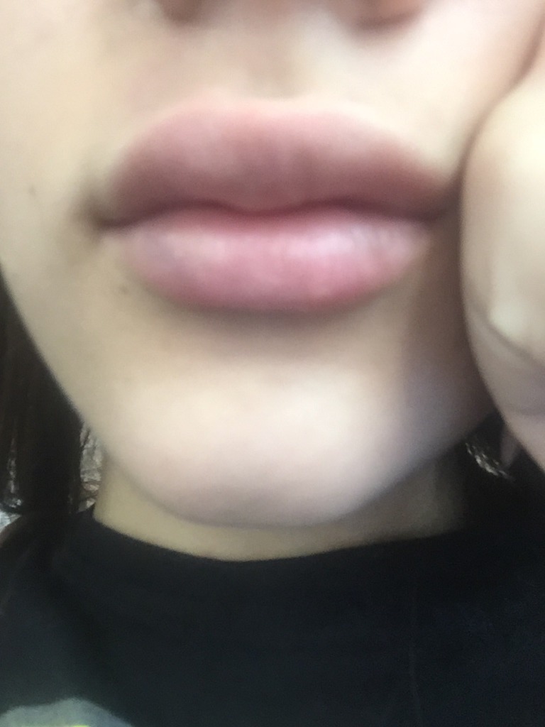 Фото 1. Неровность на верхней губе после филлера princess volume