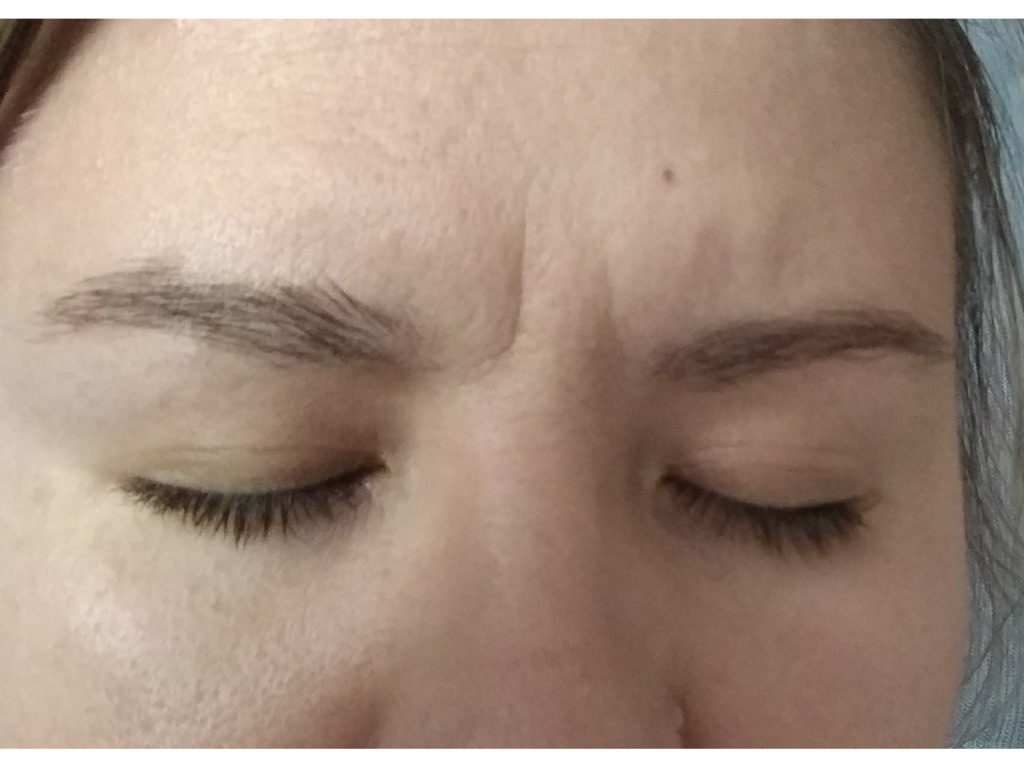 Фото 1. Как скорректировать межбровный залом?