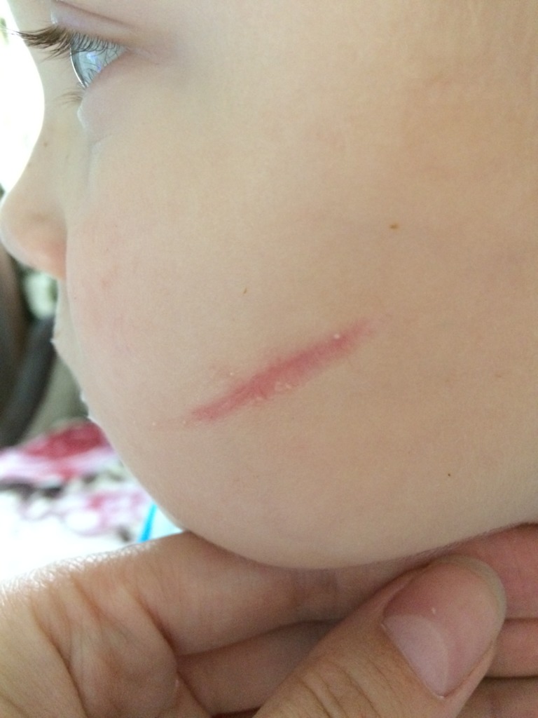 Фото 1. Чем можно убрать шрам у ребенка?